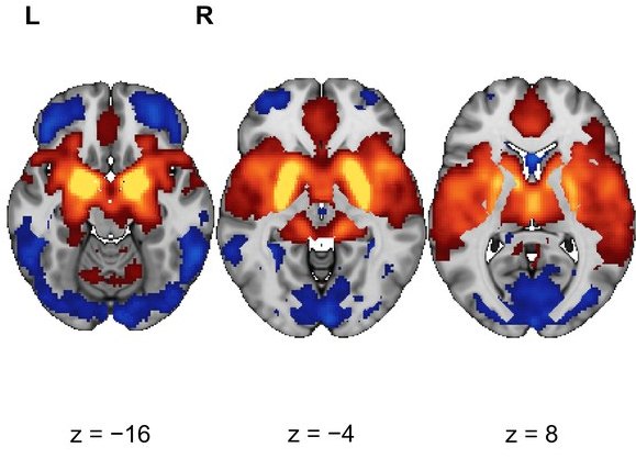 Axial slices showing positive (red-yellow) and negative (blue) resting-state connectivity of the Ch4 seed