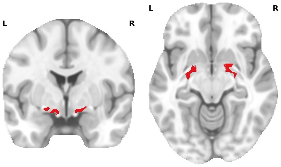 Coronal and axial MNI152 slices with the nucleus basalis of Meynert highlighted in red