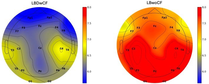 Topographic heat maps of mean dominant EEG frequency with eyes closed: mostly blue to yellow (about 6 to 7 Hz) in patients with cognitive fluctuations and red (about 8 Hz) in patients without
